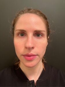 daxxify before and after