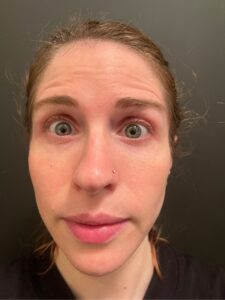 daxxify before and after