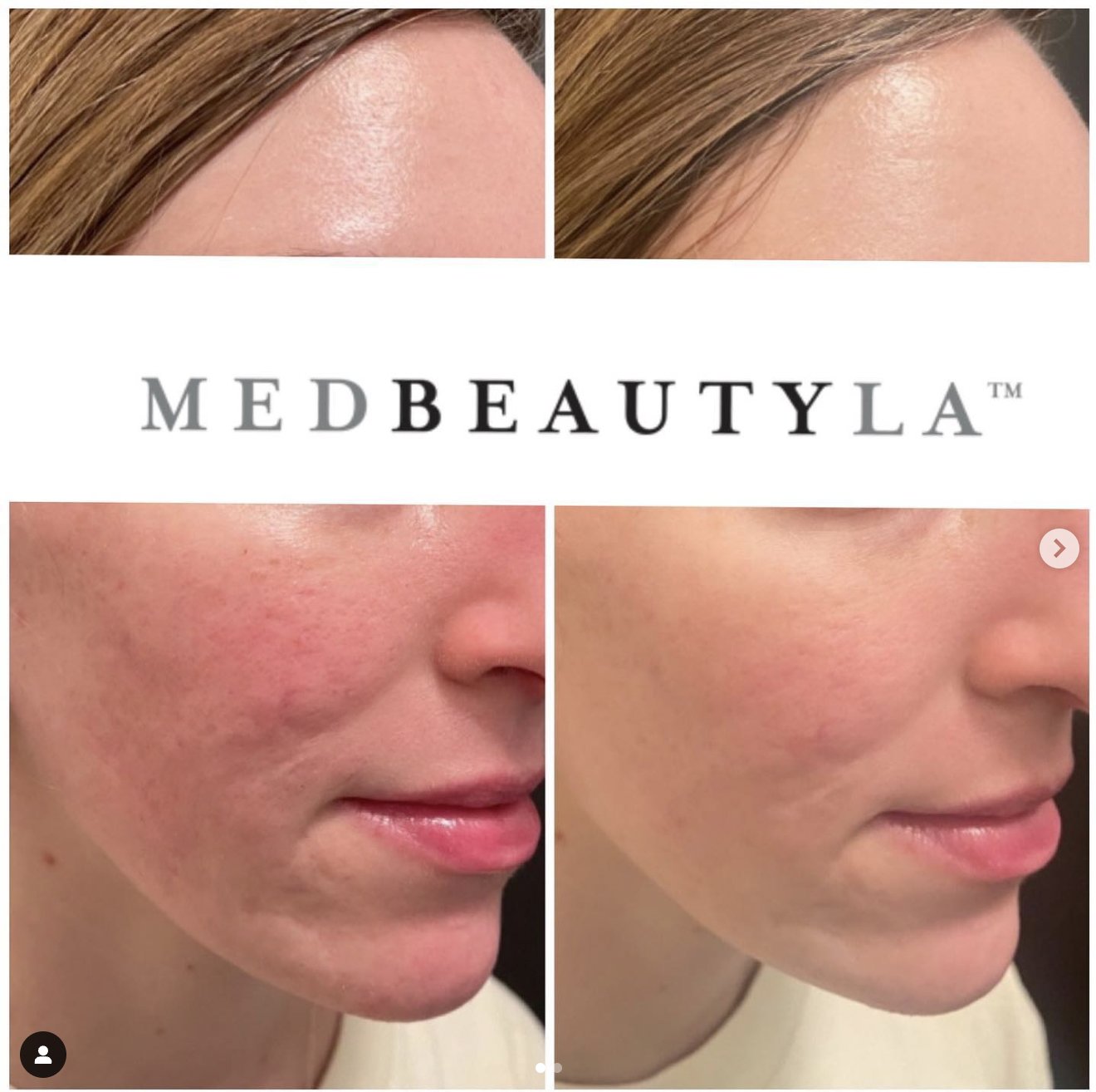 ResurFX after photo
