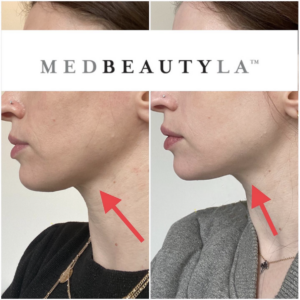 jawline filler downtown la