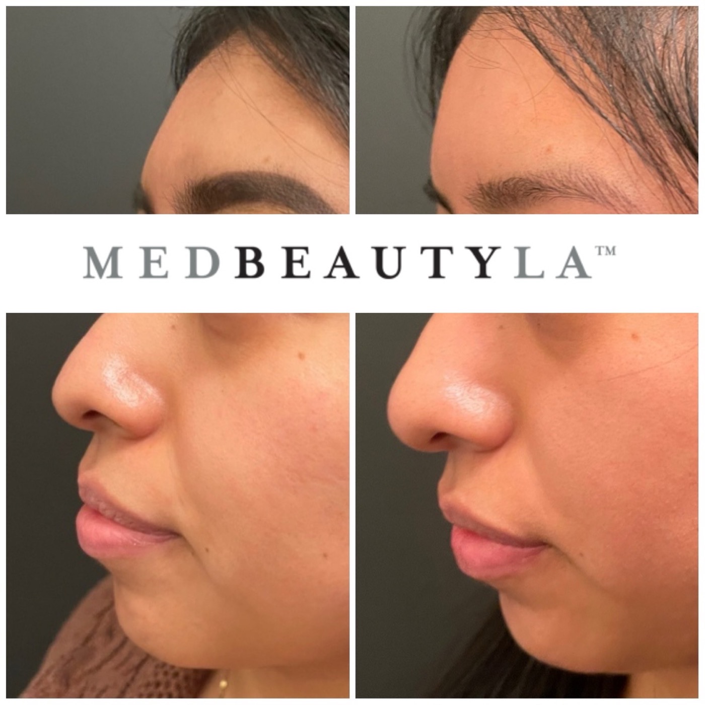 Nose filler before and after, non-surgical rhinoplasty in Los Angeles