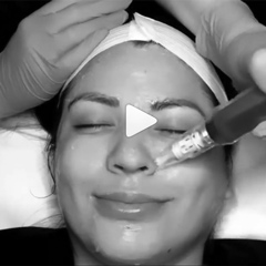 microneedling-in-action