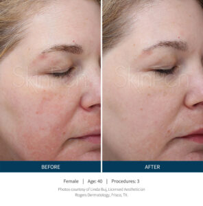 microneedling 3 sessions