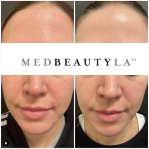 Resurfx laser before and after
