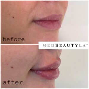 lip filler downtown los angeles