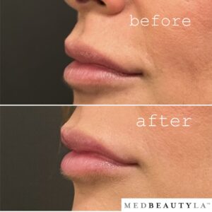 lip lase before and after profile