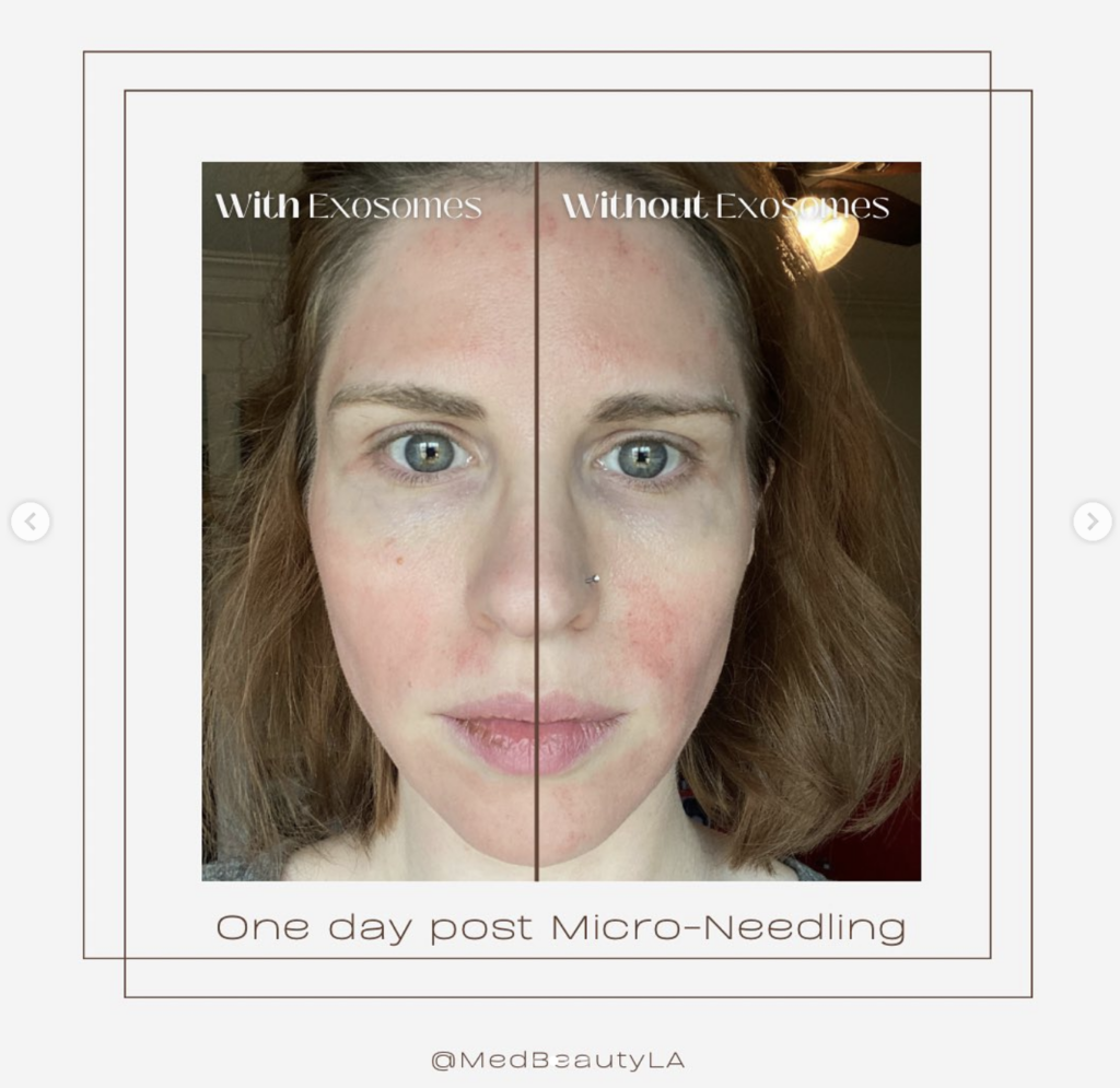 Microneedling Exosomes Before And After Photos - Medbeautyla