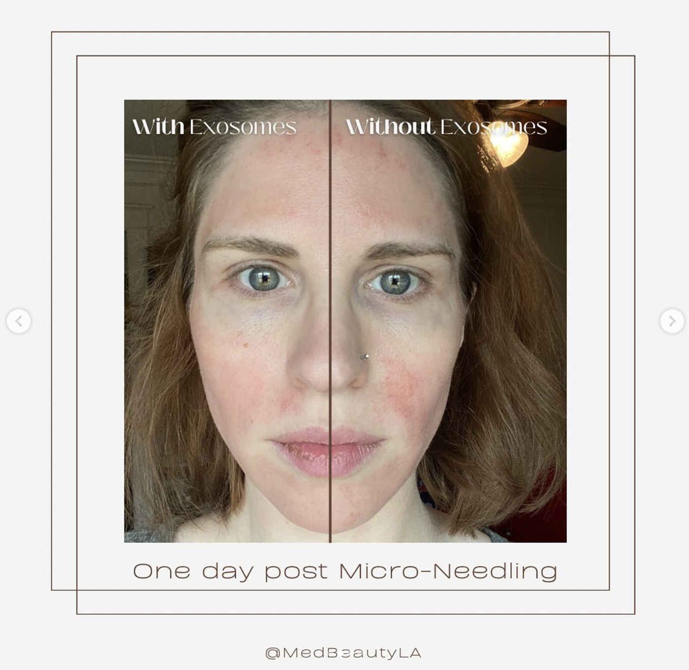 Microneedling Exosomes Before and After Photos - MedBeautyLA