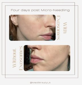 exosome microneedling before and after