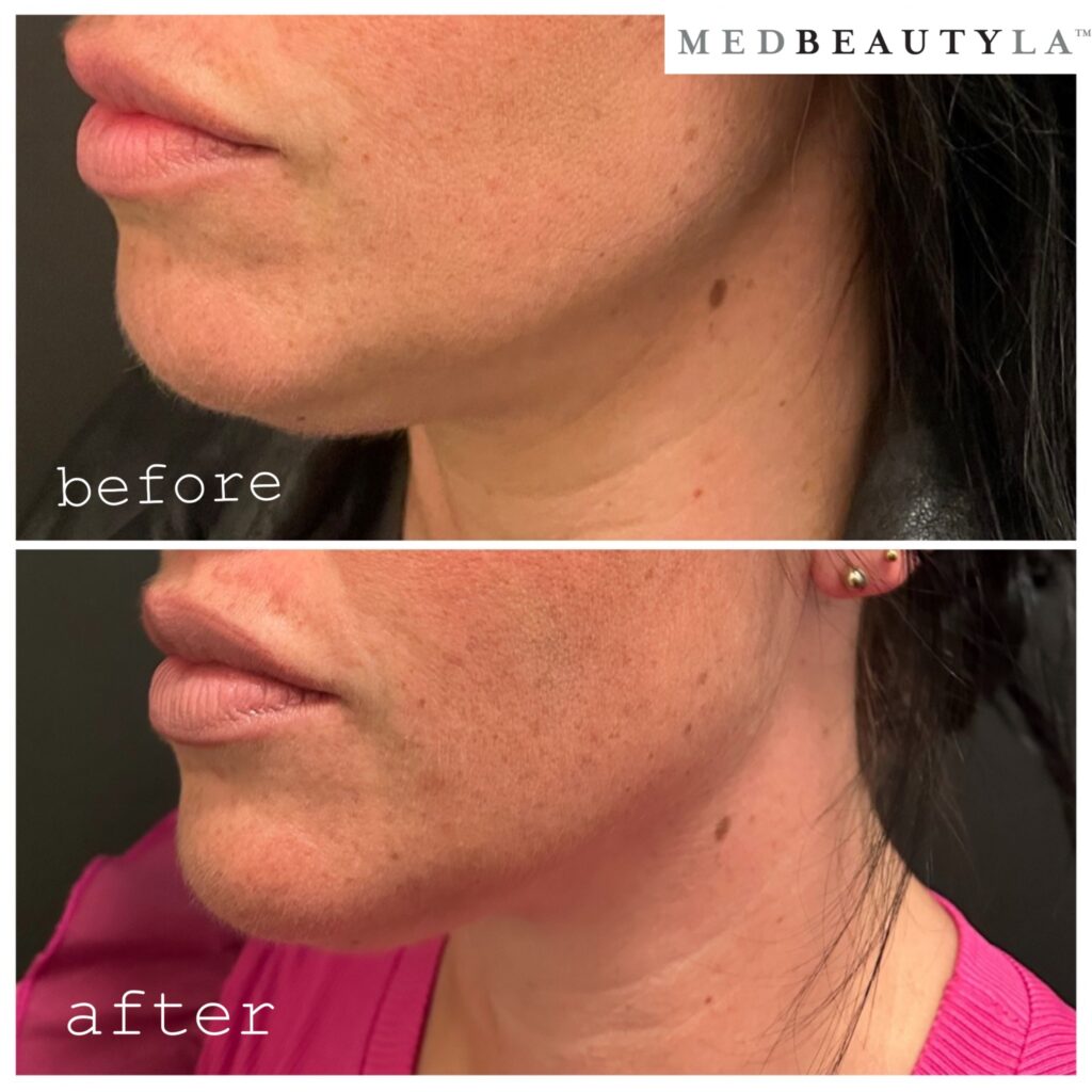 female kybella afters
