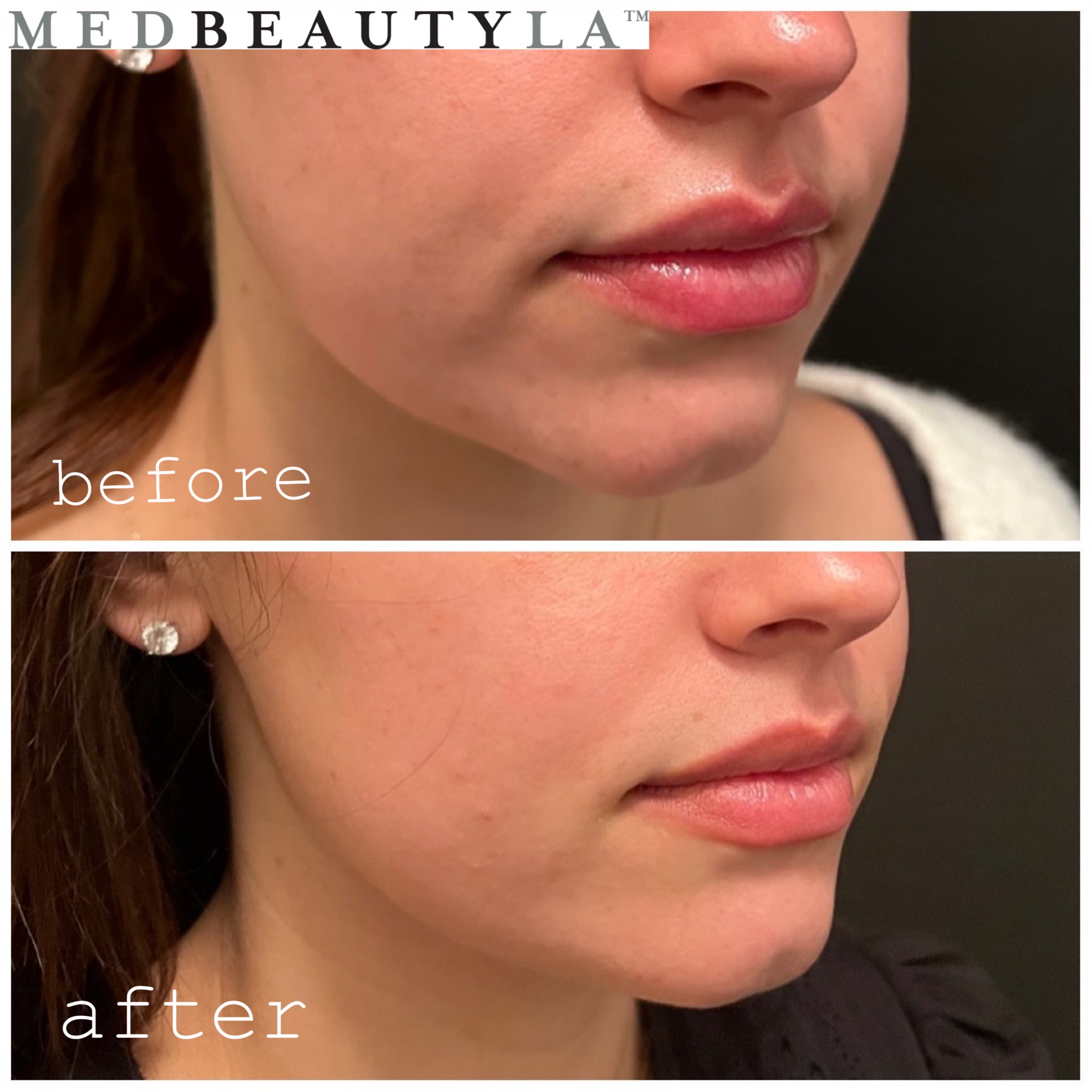 Masseter Botox® Before And After Photos In Los Angeles