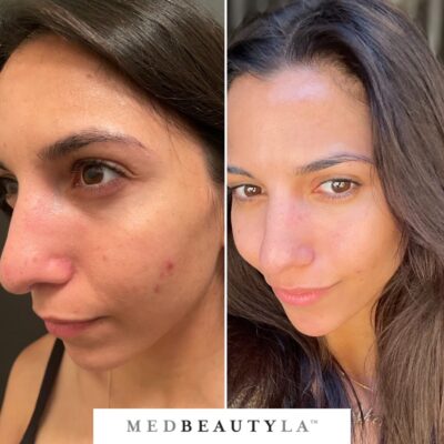 laser facials before and after la