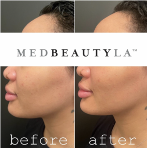 facial balancing before and after