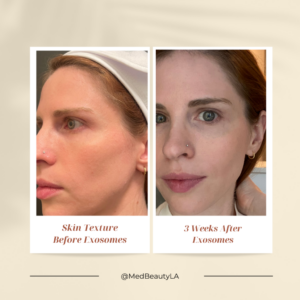 before and after microneedling with exosomes