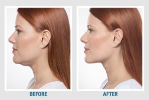 kybella before and afters