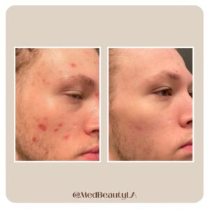 acne specialists la