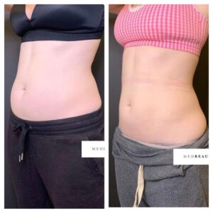 CoolSculpting before and after la