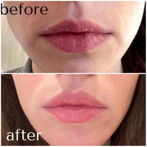 lip balancing with filler