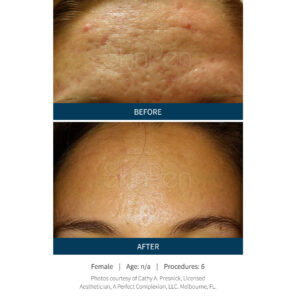 microneedling los angeles area