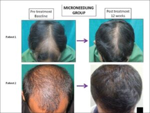microneedling for hair los study