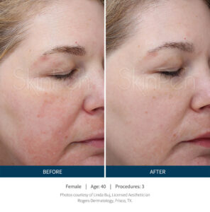 microneedling los angeles