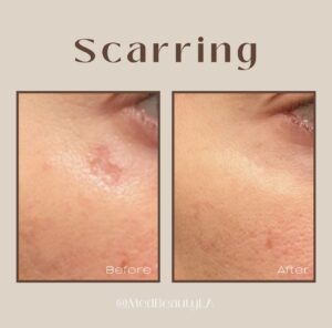 acne scarring bootcamp la