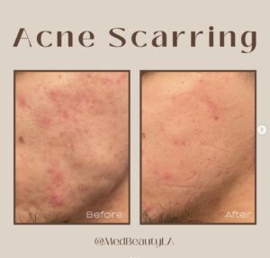 acne scar bootcamp la