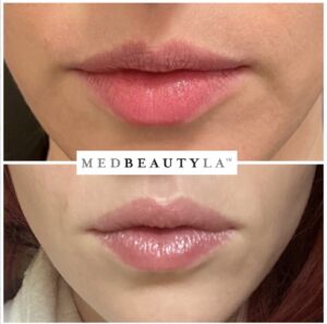 lip flip before and after