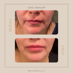 DAO Botox