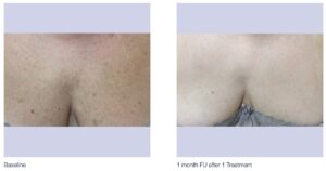 IPL chest brown spots