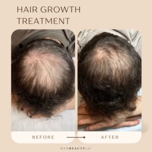 exosomes for hair loss