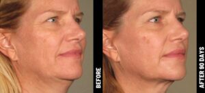 Ultherapy prime la